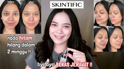 Skincare Penghilang Noda Hitam Bekas Jerawat Review Skintific Symwhite 377 Darkspot Eraser