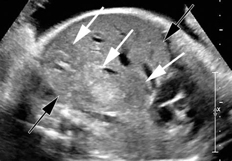 Fetal Hepatomegaly Causes And Associations Radiographics