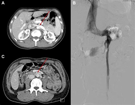 Gonadal Vein Transposition Is A Safe And Effective Treatment Of