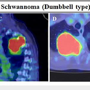 Representative Pet Ct Images Of Schwannomas And Meningiomas A B