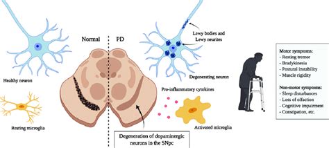 Principal Hallmarks Of Parkinson S Disease Parkinson S Disease Is