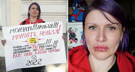 Russian Woman Sews Her Mouth Shut In Protest Of Putin