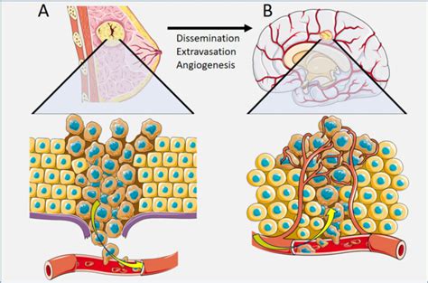 Pathophysiology Of Cancer Spread For Breast Cancer A Dissemination