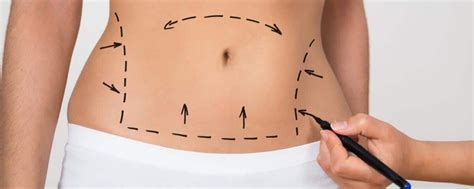 Tout Savoir Sur L Abdominoplastie Par Liposuccion Laser En Turquie