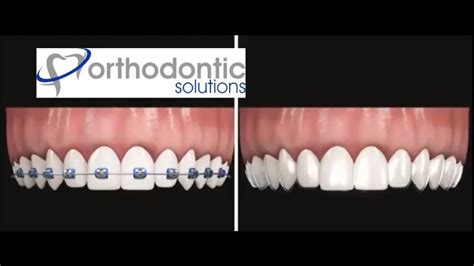 Clear Aligners Vs Braces Ods Aligners By Orthodontic Solutions Youtube