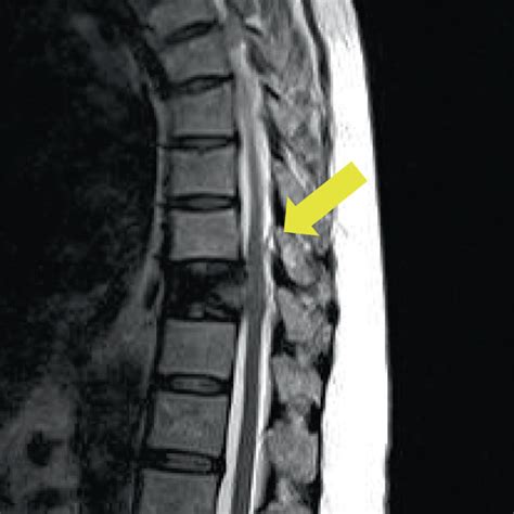 Sagittal Views Of Thoracic Magnetic Resonance Images On T2 Weighted