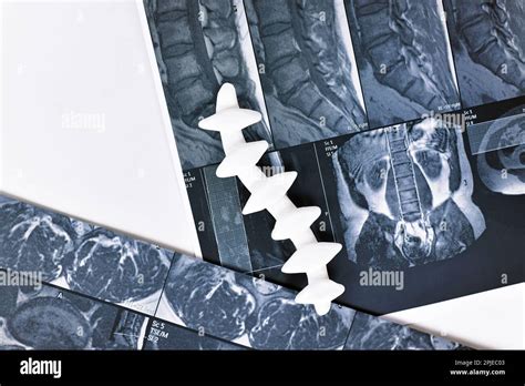 Magnetic Resonance Imaging Of Spine With Spine Model Stock Photo Alamy