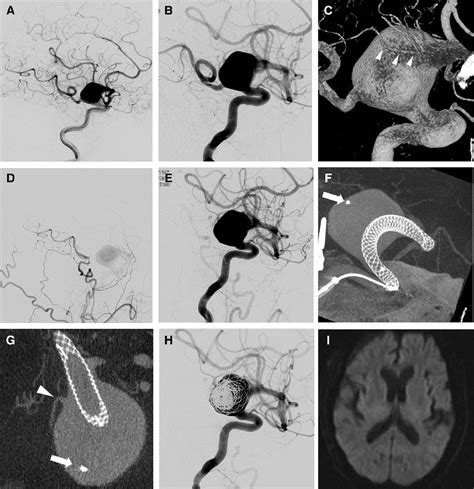 Figure 1 from Delayed Occlusion of the Anterior Choroidal Artery ...