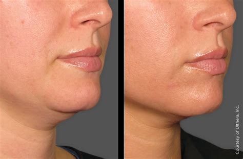 Ultherapy Face Skin Tightening In Calgary REFIRM Clinic