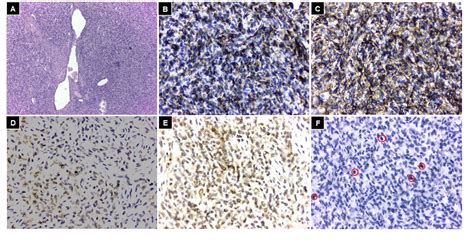 Figure From Surgical Resection Of A Presacral Solitary Fibrous Tumor