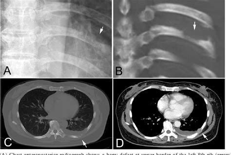 Figure From Primary Epithelioid Angiosarcoma Of The Rib On F Fdg