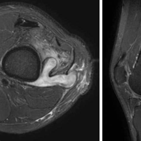 Magnetic Resonance Imaging Knee Showing A Fistulous Communication Of A Download Scientific