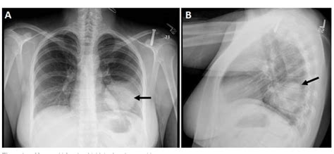 Figure From The Radiologic And Pathologic Diagnosis Of Biphasic