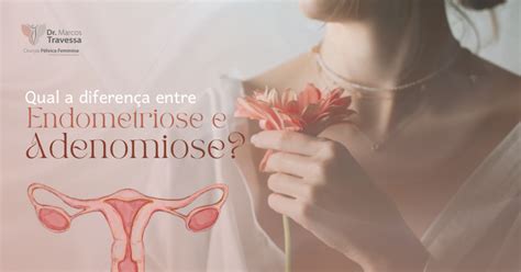 Qual A Diferen A Entre Endometriose E Adenomiose Dr Marcos Travessa