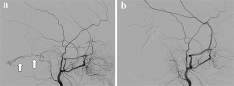 Lateral Projection Angiograms From Right ECA Injections On Our Initial