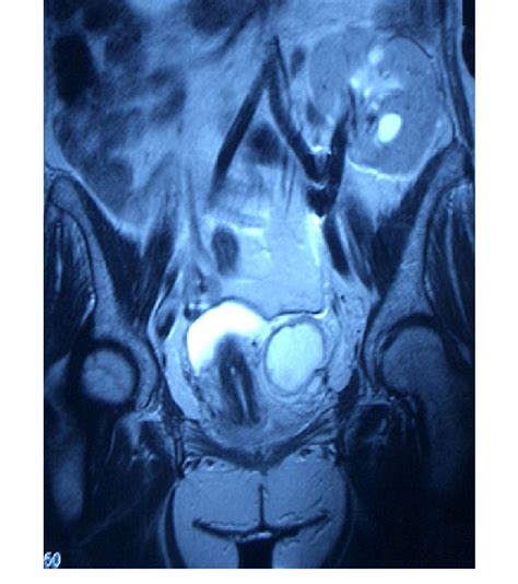 Mri Pelvis 4 9 4 9 5 Cm Irregular Mass Extending From The Left Lateral Download Scientific