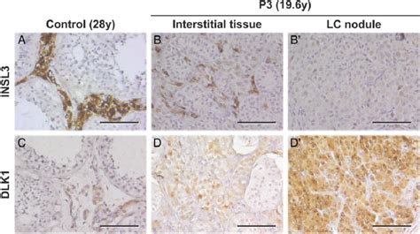 Insl3 And Dlk1 Expression In Testicular Tissue From A 28 Year Old