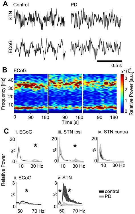 Representative Examples A Of Oscillatory Activity In The Raw Local