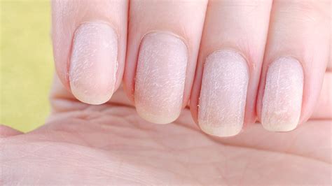 Anemia Symptoms Nails