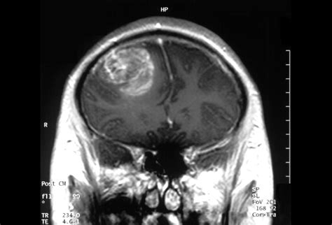 Adult Brain Tumors A Spreading Problem