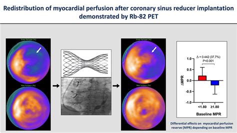 Redistribution Of Myocardial Perfusion After Coronary Sinus Reducer