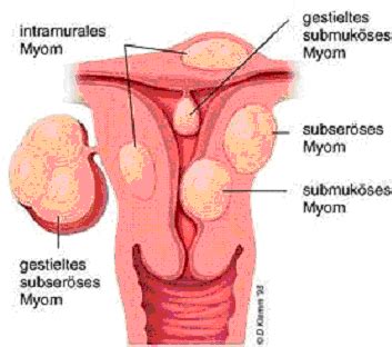Einteilung Von Myomen Myome De