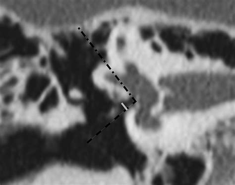 Oval Window Niche Height Quantitative Evaluation With Ct Before Stapes Surgery For Otosclerosis