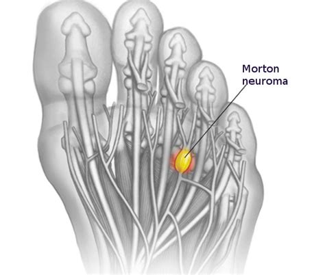 Morton Neuroma Statpearls Ncbi Bookshelf