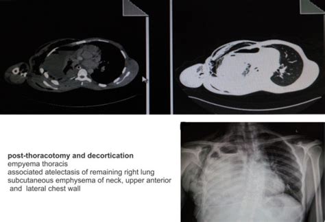 Chest Radiograph And Computed Tomography Ct Scan Illustrating Download Scientific Diagram