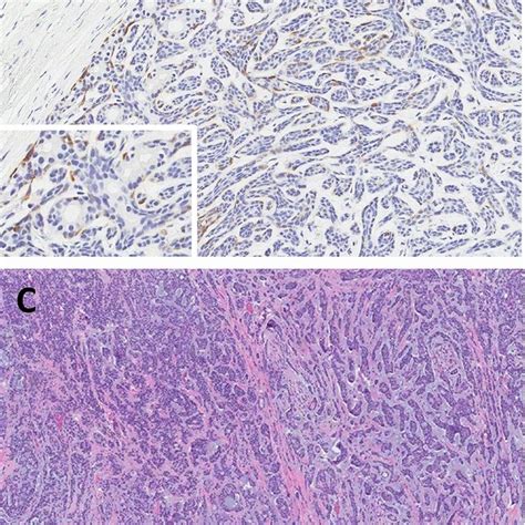 Gfap Expression In Other Types Of Salivary Gland Tumours Basal Cell