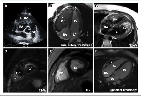 Figure 1 From A Rare Case Of Testicular Teratoma Metastasizing To The Right Ventricle Semantic