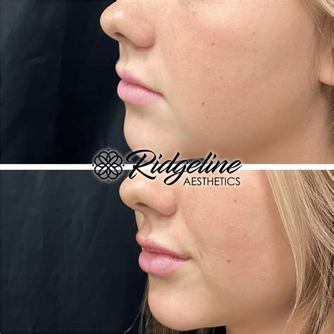 Lip Fillers And Injections Ridgeline Aesthetics A Premier Med Spa