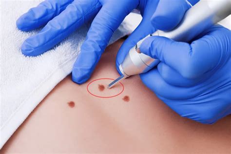 Skin Tags Warts Freckles Moles Removal Dr Sajjas Clinic In Tirupati