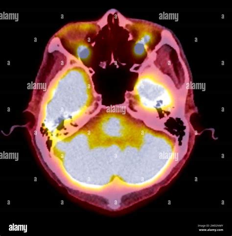 A Pet Ct Scan Image Is A Diagnostic Visualization Combining Positron