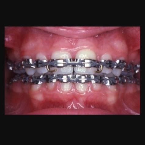 Dr David On Instagram “throw Back Thursday Braces Have Come A Long Way This Is What Braces