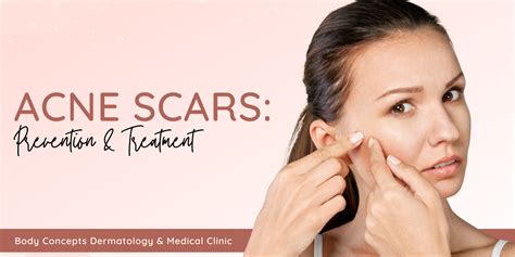 Addressing Acne Scars A Comprehensive Guide To Treatment And