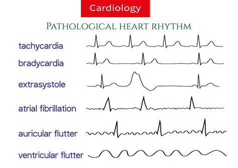 Naturally Eliminate Heart Arrhythmia Dan Hammer Health Ltd