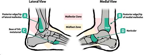 Ankle Sprain Explained A Physiotherapists Perspective The Physio Shop