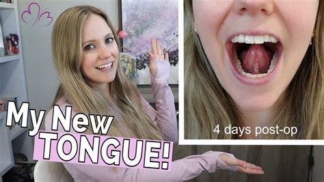 Adult Tongue Tie Release Experience Full Tie Revision Story With Before And After Photos Youtube