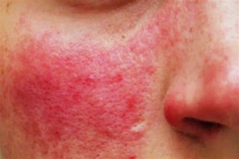 Couperose Rosacea Hautarztzentrum Kiel