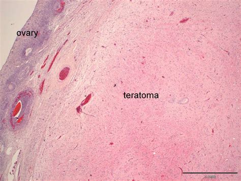 Ovarian teratoma | Case Study | Cytopath