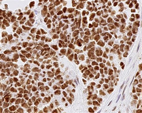 Pathology Outlines Choroid Plexus Tumors Papilloma Atypical