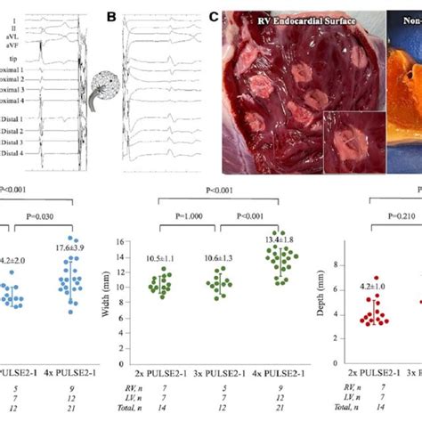 Endocardial Pulsed Field Ablation Lesions A Lattice Tip Catheter