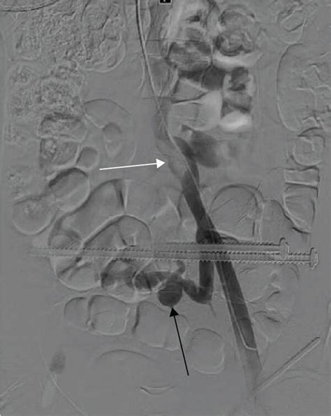 A Digital Subtraction Venography Image Demonstrating Compression And