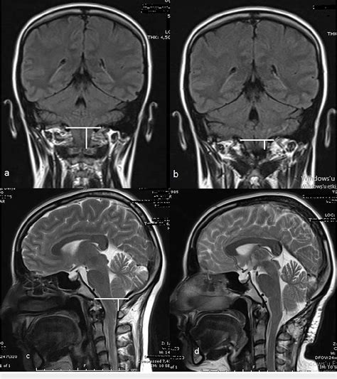 Figure 2 From Surgical Outcomes Of Adult Chiari Malformation Type 1