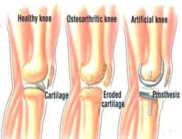 Protesis De Rodilla Arrodillarse Edad Adecuada Y Testimonios Neurat