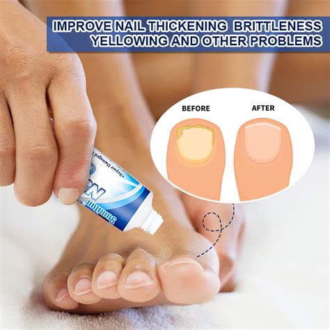 Buy Toenail Fungus Treatment Creamnail Fungus Stopfingernail Fungus