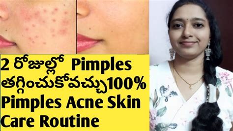 Pimples Acne Removal On Face At Home In Telugu How To Get Rid Of