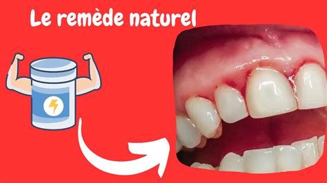 Gingivite 4 compléments naturels pour la combattre Inflammation des