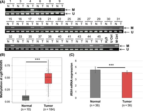 Aberrant Dna Methylation And Reduced Expression Of Irx In Primary